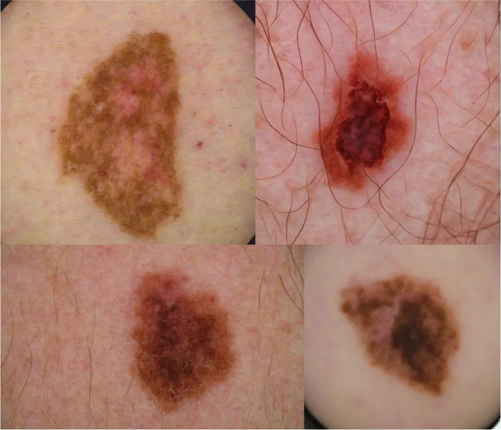 synthetic melanoma